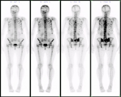 Bone scan_Baiduwiki