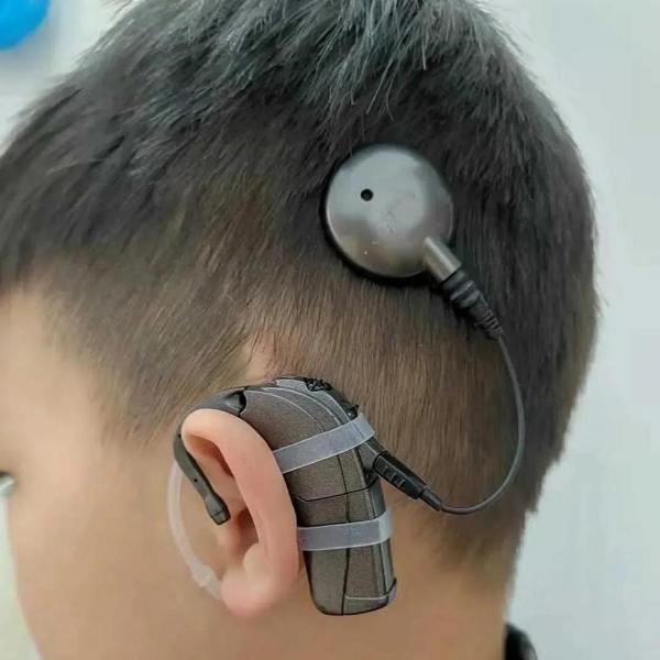 よみがえった音の世界—人工内耳を使用して 人工内耳_百度百科