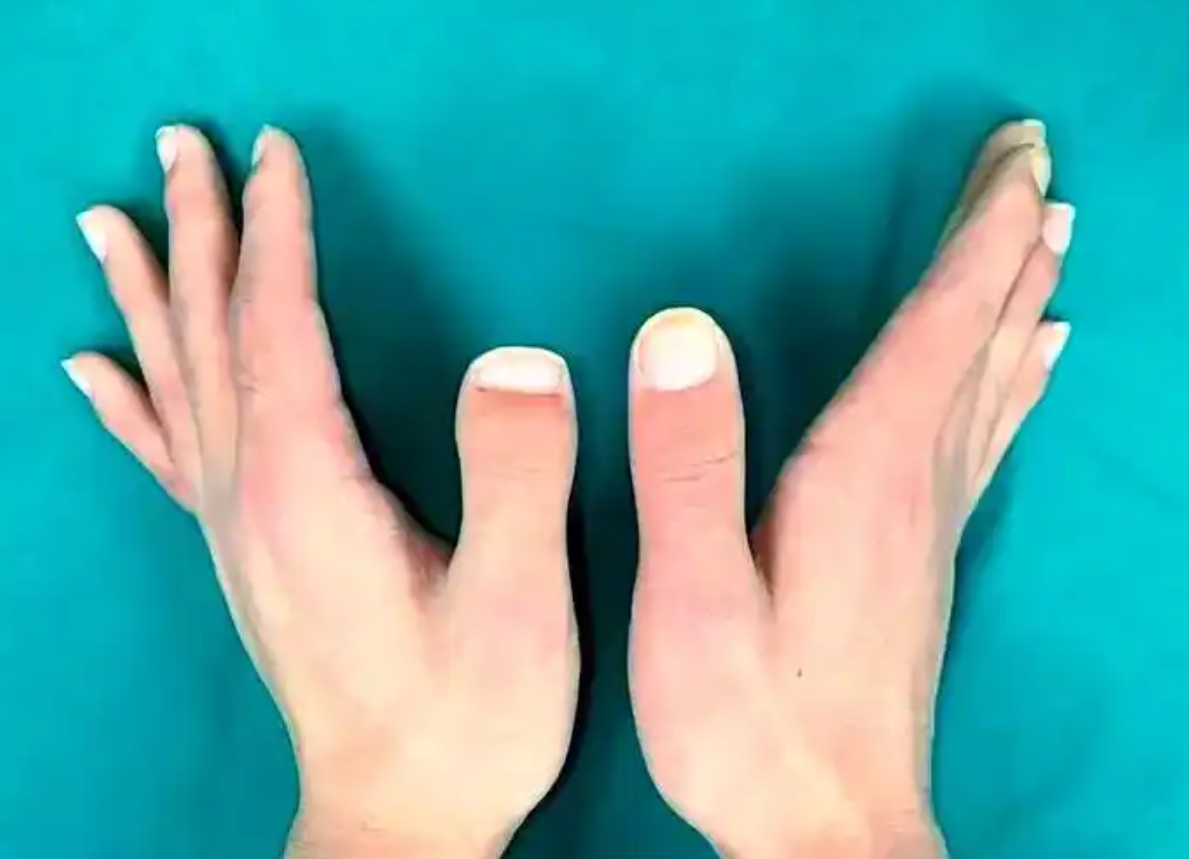 短指症 親指 確率